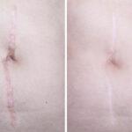 Hypertrophic,Keloid,Scar,On,Woman,Face,Before,And,After,Laser